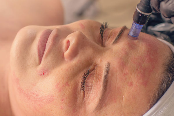 Microneedling_Bleeding-600×400