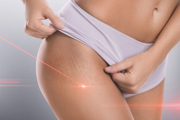 RFSculpt_Stretch_Marks-600×400